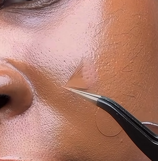 A transparent hydrocolloid patch being lifted from skin with tweezers